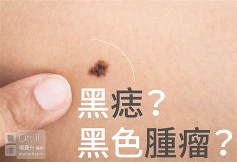 陰莖 黑痣|手術切除還是其他方法？陰莖黑痣、陰囊和包皮痣的處理方式